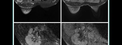 Node-RADS for Predicting Lymph Node Involvement in Breast Cancer