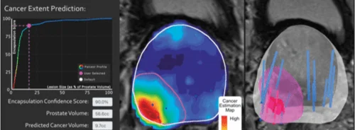 Improving Prostate Cancer Treatment Through AI-Assisted Contouring