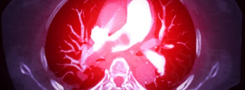 Optimising Contrast Flow Rates in CT Pulmonary Angiography