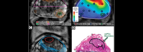 AI-Assisted Contouring in Prostate Cancer: Enhancing Accuracy &amp; Decision-Making