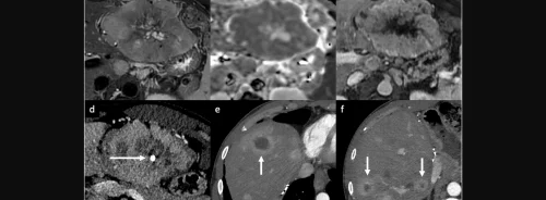 Understanding Peripheral Arterial Enhancement of Focal Liver Lesions