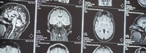 Unveiling Brain Flow: Advanced MRI for Neurological Diagnosis