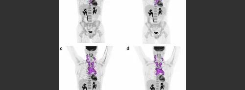 [18F]FDG-PET/CT for Hodgkin Lymphoma Staging &amp; Therapy Monitoring