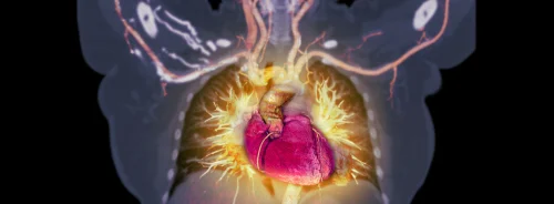 Clinical Significance of Differential Ventricular Stroke Volumes: the MESA Study