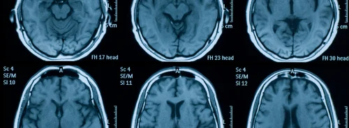 Denoising AI Model for Accelerated Parallel Brain MRI