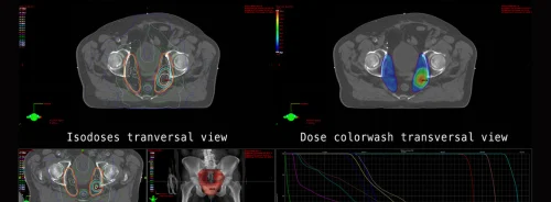Composite image showing PET/CT fusion scans, isodose mapping, and dose-volume histograms used in radiation therapy planning and oncology diagnostics.&nbsp;