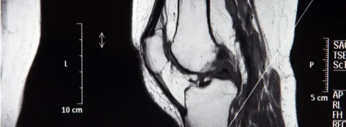 MRI scan image of a human knee joint in sagittal view, showing detailed bone, cartilage, and soft tissue structures used for diagnostic evaluation.&nbsp;