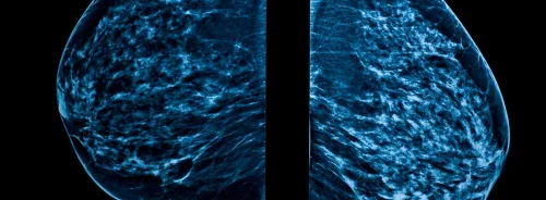 Bilateral mammogram showing right and left mediolateral oblique (MLO) views