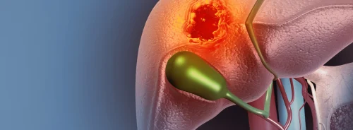 Medical illustration of a liver with&nbsp;a focal&nbsp;tumour.&nbsp;
