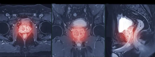 Pelvic MRI series in axial, coronal and sagittal views with the prostate region highlighted.&nbsp;