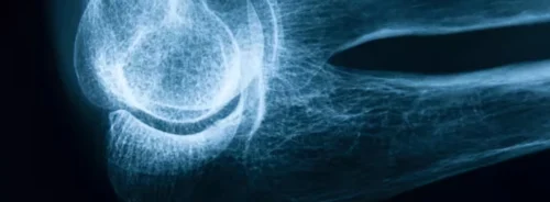 Lateral elbow X-ray showing humerus,&nbsp;radius&nbsp;and ulna for trauma assessment