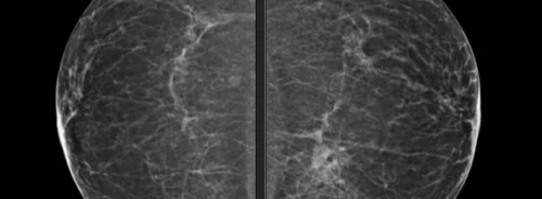 High-resolution mammography scan showing breast tissue on a black background.&nbsp;