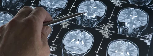 Doctor pointing at abnormal area on brain MRI to support clinical decision-making.&nbsp;