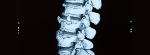 3D CT scan of the lumbar spine showing vertebrae and degenerative structural changes.&nbsp;