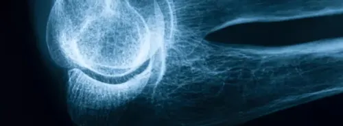 Lateral elbow X-ray showing humerus,&nbsp;radius&nbsp;and ulna for trauma assessment