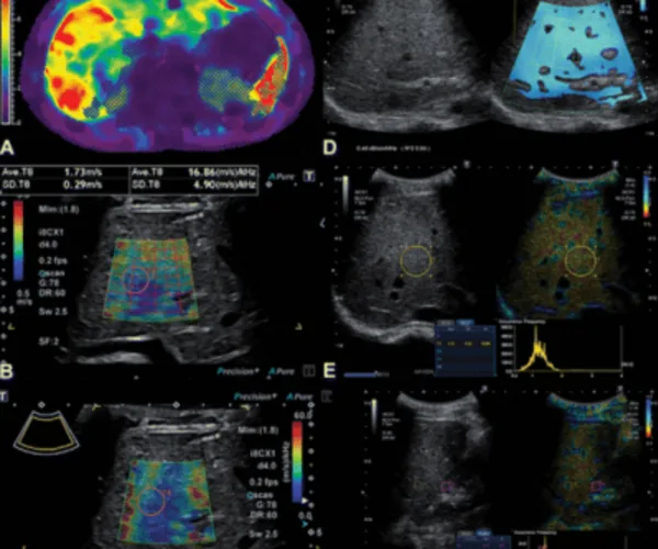 Assessing Liver Disease in Youth: A Comparative Study of Ultrasound and MRI Techniques