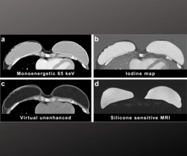 Assessing Silicone Breast Implants Ruptures with PCCT