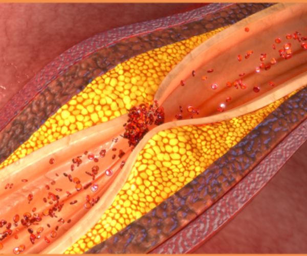 Prognostic Significance of CAD-RADS in Suspected Coronary Artery Disease