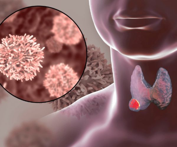 Enhancing Thyroid Nodule Characterisation: A CT-Based Radiomics Approach