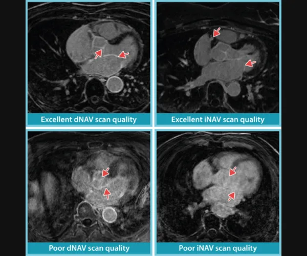 Performance of iNAV and dNAV Cardiac MRI Techniques for Atrial Fibrosis