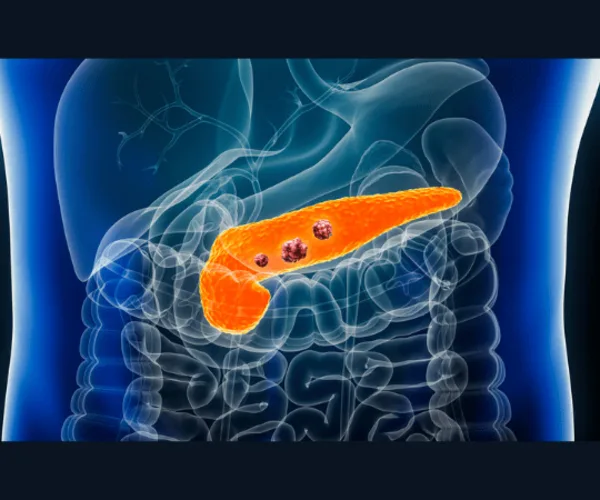 The Potential of Signal Enhancement Ratio in Pancreatic Adenocarcinoma