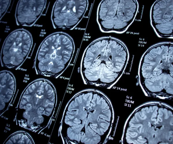 Enhancing Brain Metastases Visualisation With Dynamic Contrast-Enhanced MRI