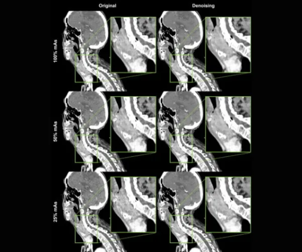 AI Denoising in Neck CT Imaging Enhances Diagnostic Accuracy