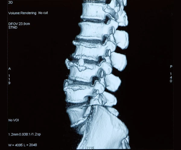 3D CT scan of the lumbar spine showing vertebrae and degenerative structural changes.&nbsp;