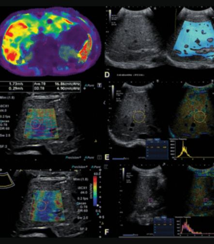 Assessing Liver Disease in Youth: A Comparative Study of Ultrasound and MRI Techniques