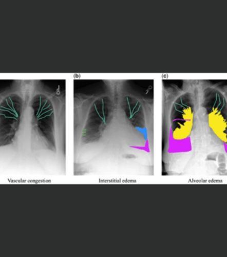 Automated Detection and Localization of Pulmonary Oedema Features in Chest X-Rays