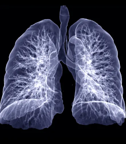 How to Better Manage Subsolid Lung Nodules?