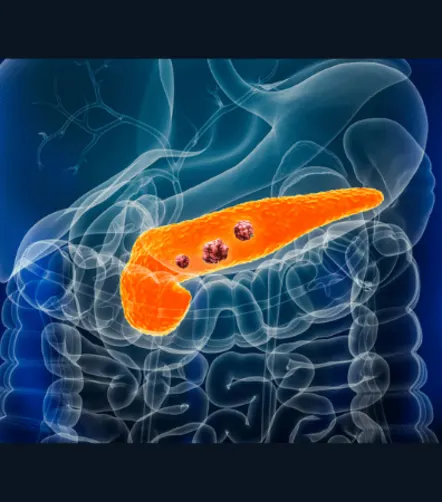 The Potential of Signal Enhancement Ratio in Pancreatic Adenocarcinoma