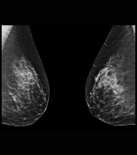 Abbreviated MRI as a Supplemental Cancer Screening Tool for Dense Breasts