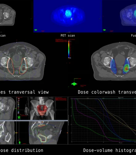Composite image showing PET/CT fusion scans, isodose mapping, and dose-volume histograms used in radiation therapy planning and oncology diagnostics.&nbsp;