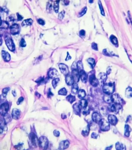 Microscopic view of cancer cells stained with haematoxylin and eosin.&nbsp;