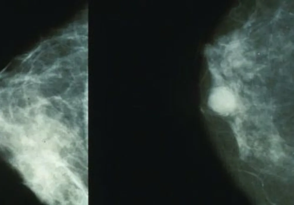Test Set Mammography Data Can Reasonably Describe Actual Clinical Reporting 