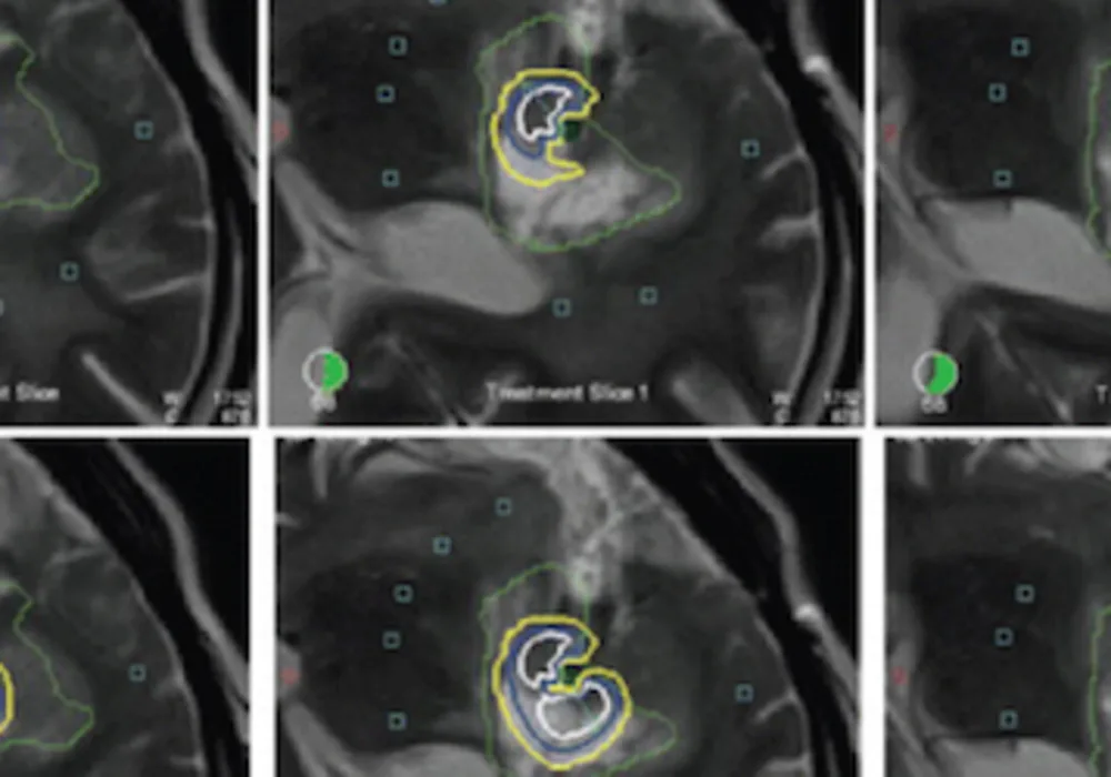 New MRI-Guided Laser Treatment for Brain Tumour