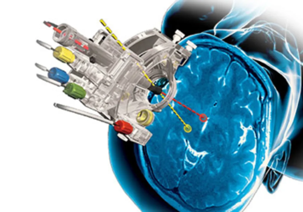 MRI Interventions&#039; ClearPoint System Used in Laser Ablation Procedures for Brain Tumour and Epilepsy