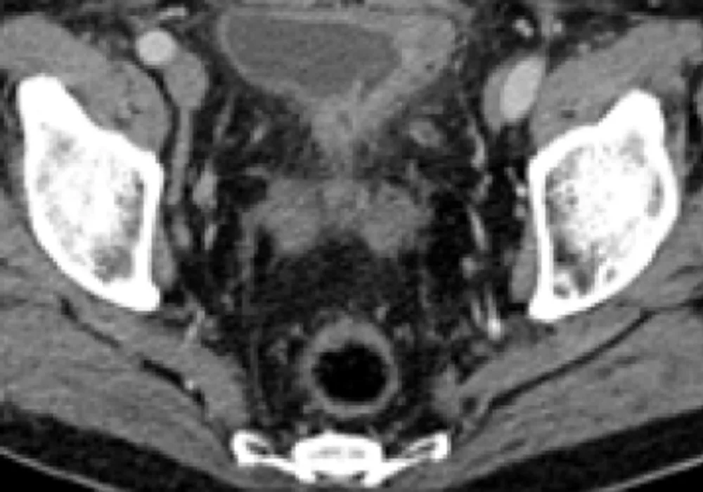 Bladder Cancer Imaging