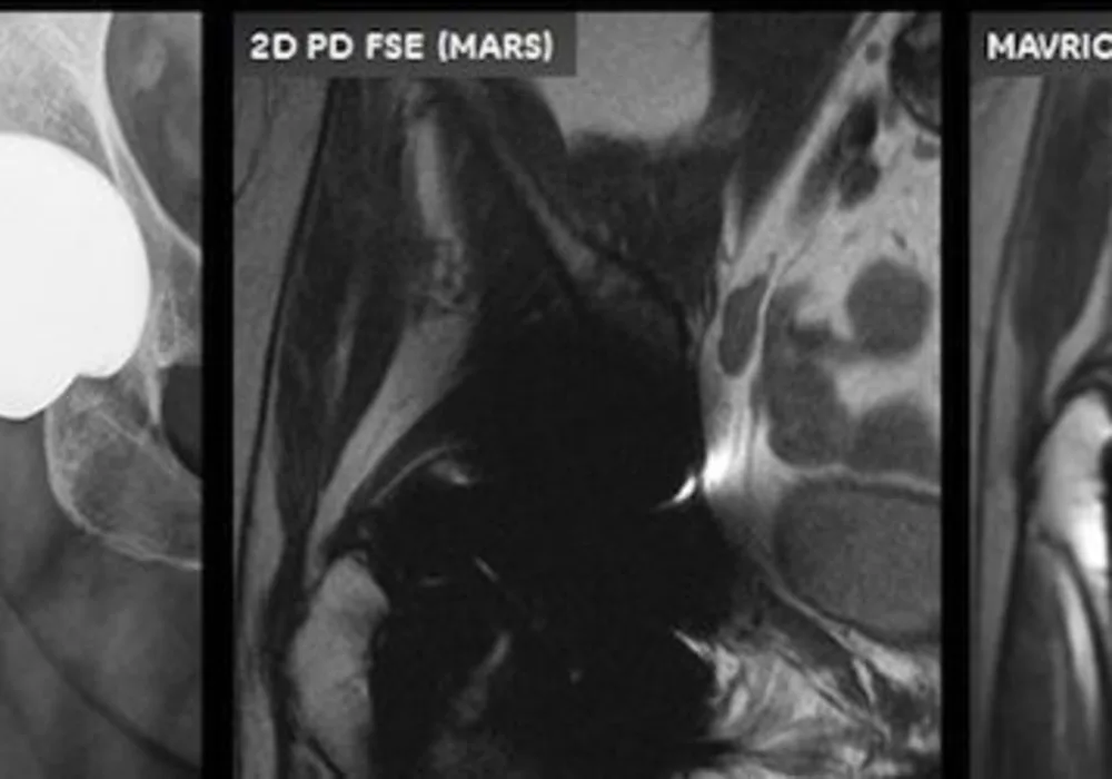 MR Challenges in Imaging Joint Replacements and Devices 