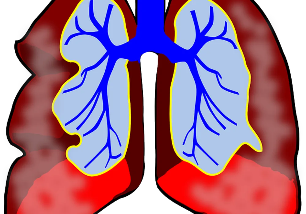 Digital Chest Tomosynthesis Possible Lung Cancer Screening Tool