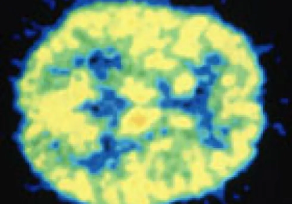 New Virus Isolated from Patients with Severe Brain Infections