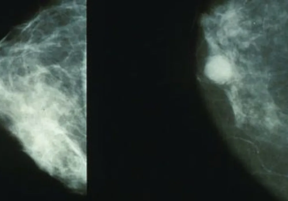 Even Expert Mammographers Can Miss Breast Cancer Cases 