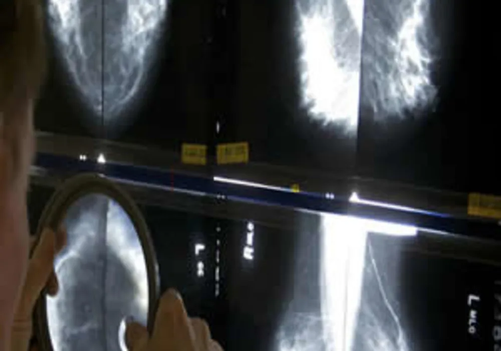 USPSTF New Mammography Guidelines Could Cost Thousands of Lives