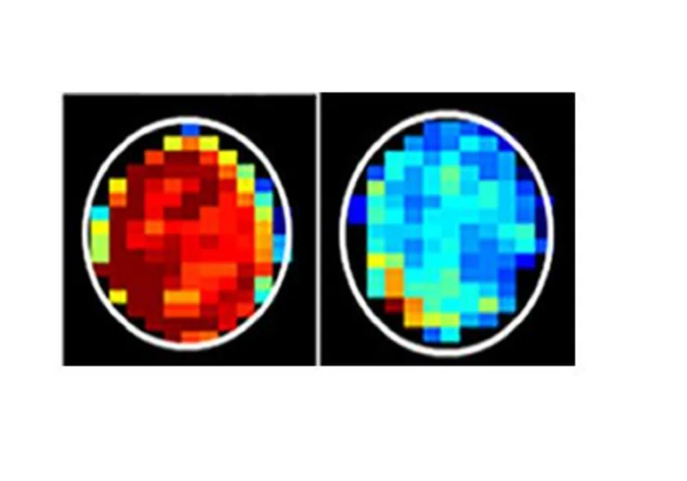 MRI Detects Cancerous Cells 