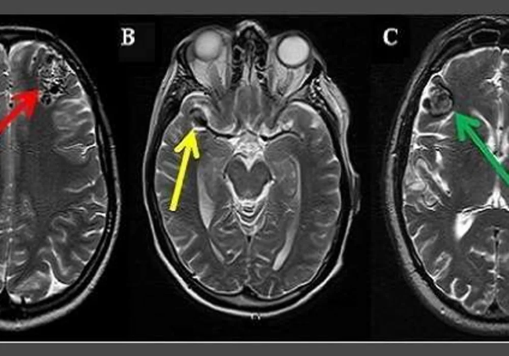 Managing Incidental Findings Found During Neuroimaging