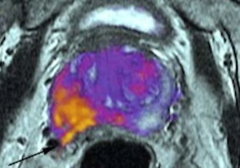 RSI-MRI Detects Spread of Cancer Beyond Prostate