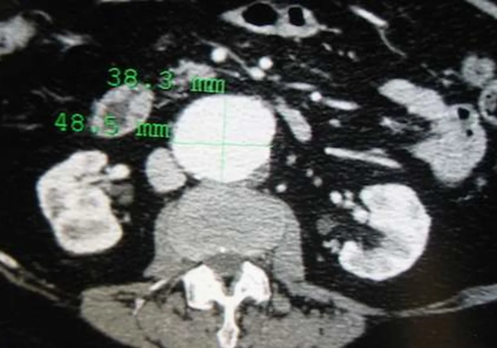 Overdiagnosis Risk In Abdominal Aortic Aneurysm Screening