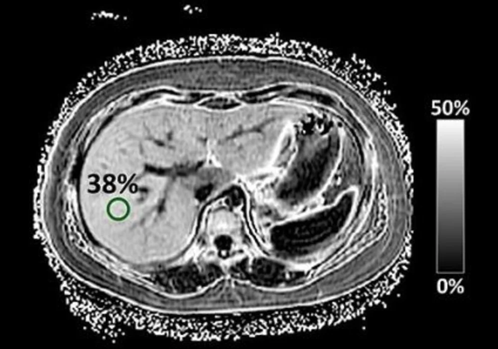 MRI Technique for NAFLD in Children