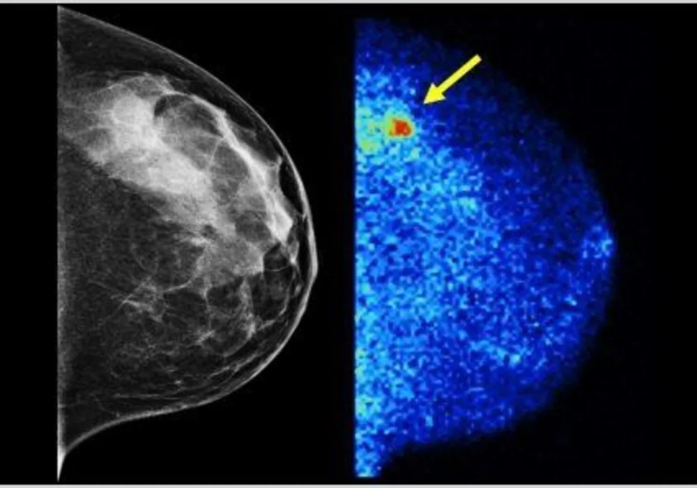 New Breast Exam Quadruples Breast Cancer Detection